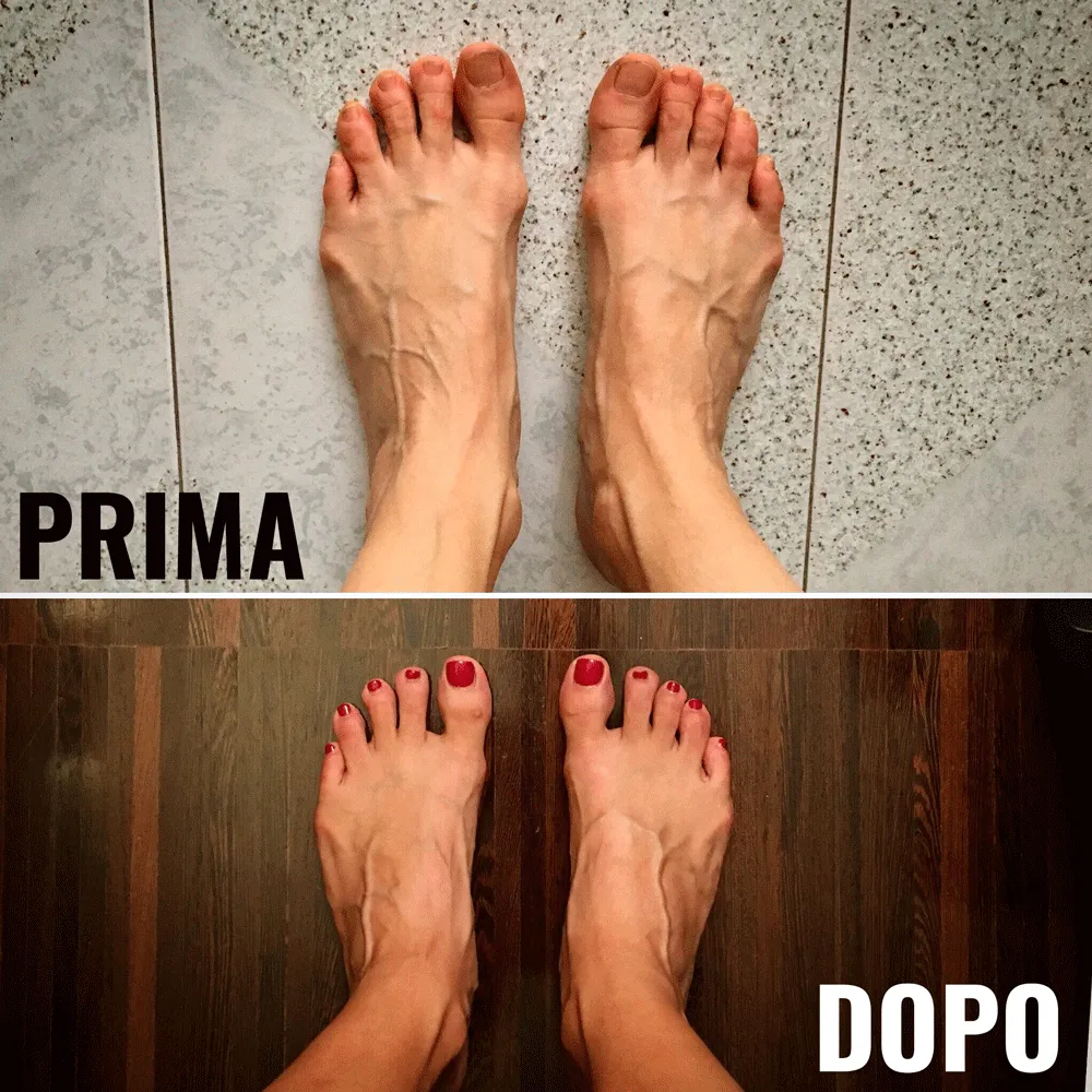 piedi prima e dopo